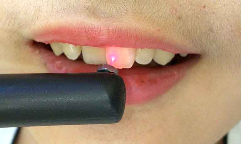 ダイアグノデント