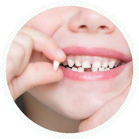 乳歯を虫歯にさせない