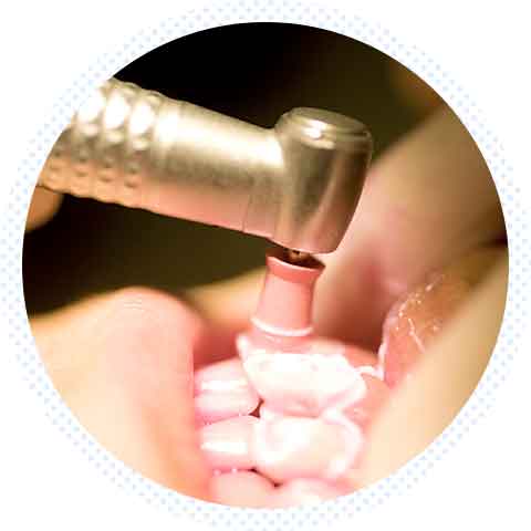 歯のクリーニング