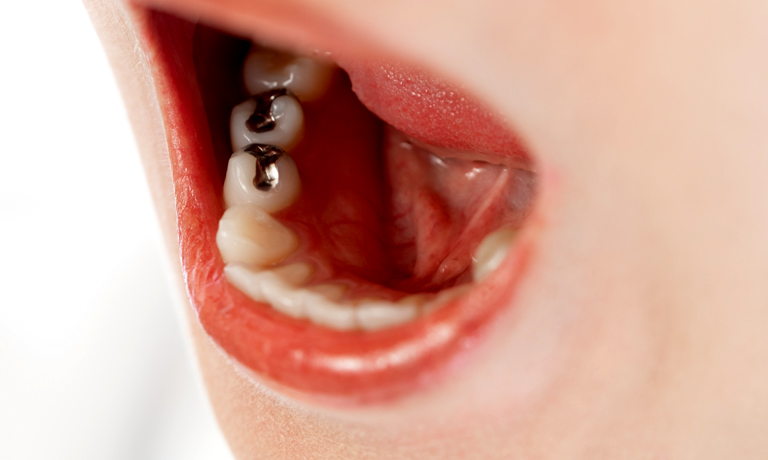 銀歯が気になる方へ