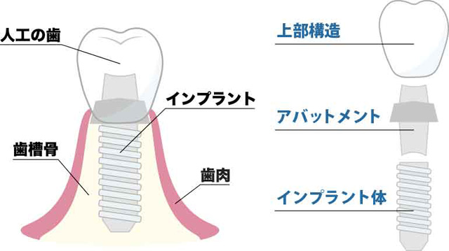 インプラントとは