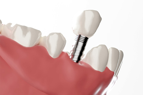 周囲の歯に負担をかけない