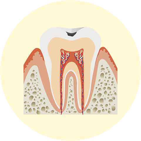 エナメル質の虫歯