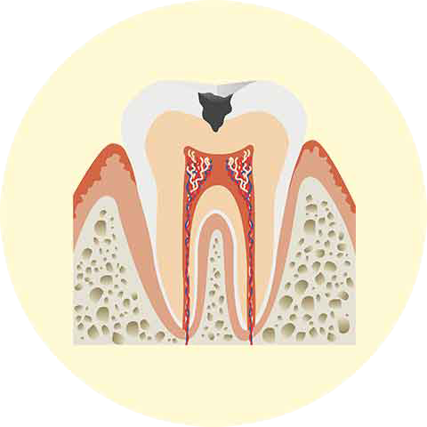 象牙質の虫歯