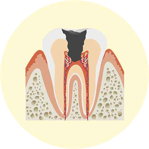 象牙質の虫歯