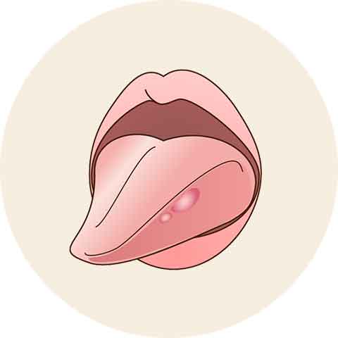 顎関節症や口内炎の原因になっている場合