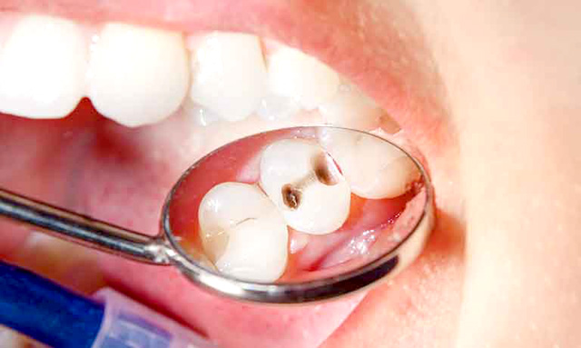 虫歯にかかりやすい