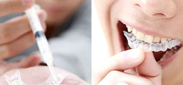 ホームホワイトニング