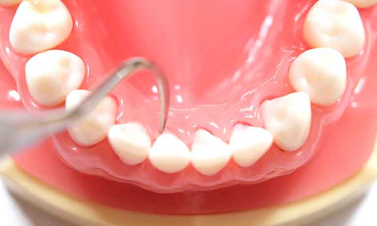 スケーリング(歯石取り)