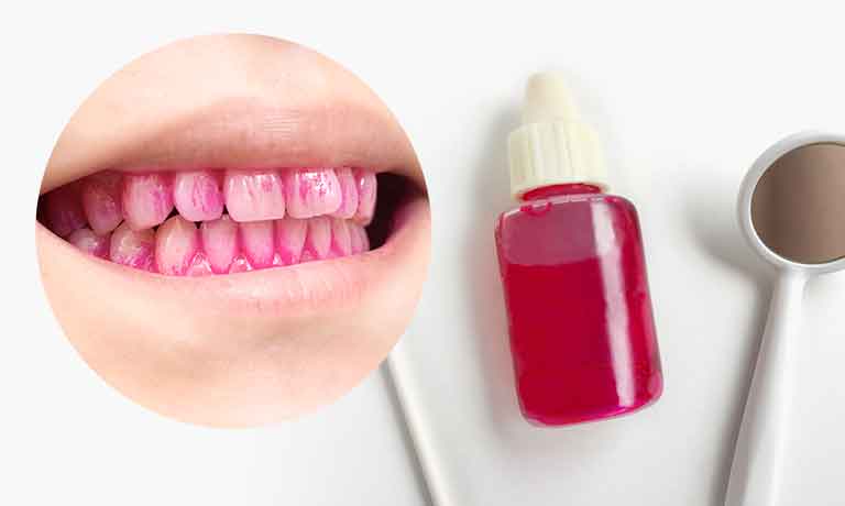 歯垢(プラーク)の染め出し